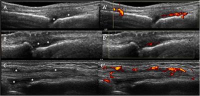 When and how should we use imaging in individuals at risk of rheumatoid arthritis?